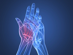 arthritic hand